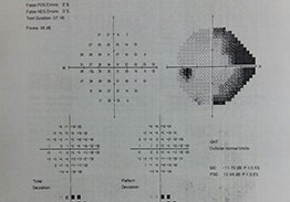 glaucoma